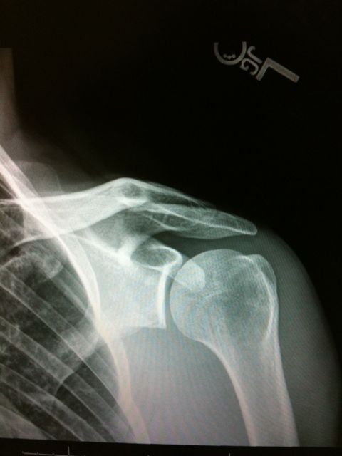 My left shoulder x-ray